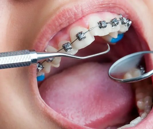 Ortodontist Kimdir? Ortodontist Ne Kadar Kazanır? Ağız ve diş sağlığı alanında önemli bir uzmanlık dalı olan ortodonti, dişlerin ve çene yapısının düzgün hizalanmasını sağlayan tedavileri kapsar. Bu alanda görev yapan ortodontist, dişlerdeki çapraşıklıkları, çene bozukluklarını ve kapanış problemlerini tedavi eden diş hekimidir. Ortodontistler, hem estetik hem de fonksiyonel açıdan sağlıklı bir ağız yapısı oluşturmayı hedefler. Konulu bir haber görseli.